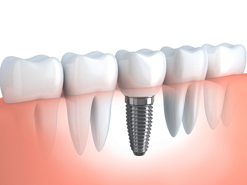 Dental Implants can make a big difference!