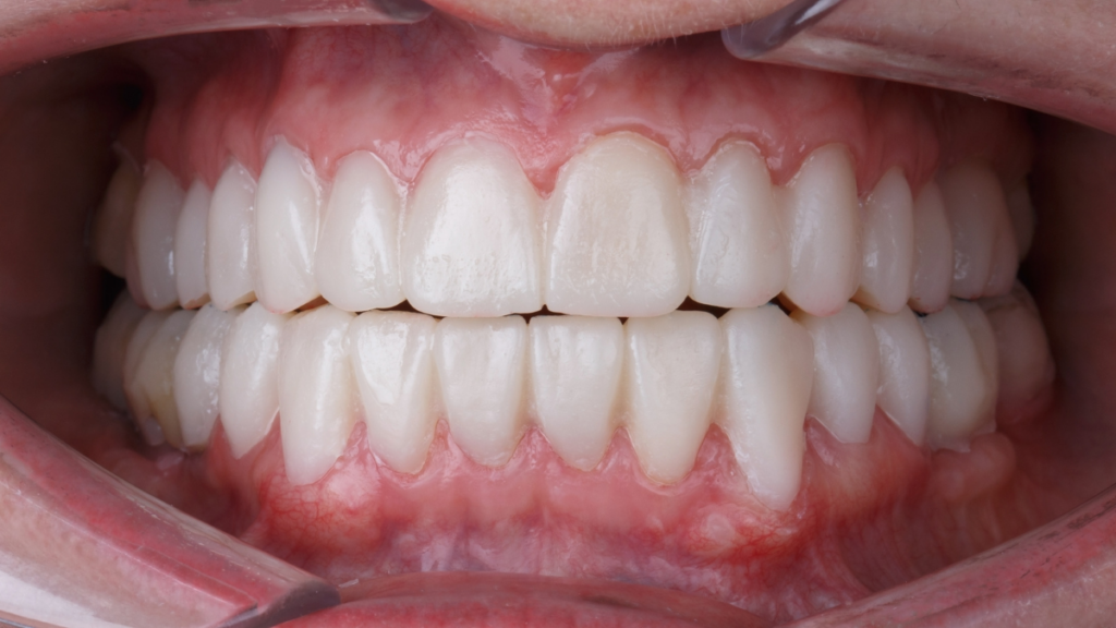 Full-mouth dental restoration showing healthy, aligned teeth at Broad St Smiles in San Luis Obispo, CA.