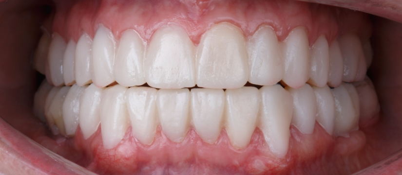 Full-mouth dental restoration showing healthy, aligned teeth at Broad St Smiles in San Luis Obispo, CA.
