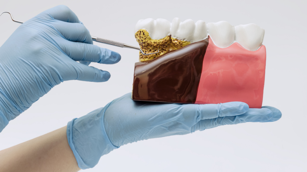 Dental model demonstrating gum disease and periodontal care at Broad St Smiles in San Luis Obispo, CA.