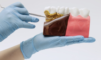 Dental model demonstrating gum disease and periodontal care at Broad St Smiles in San Luis Obispo, CA.