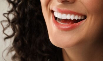 Close-up of a woman smiling, showing bright porcelain veneers.