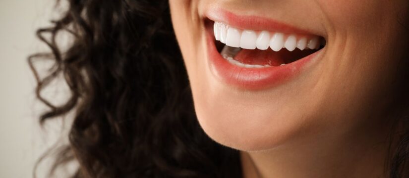 Close-up of a woman smiling, showing bright porcelain veneers.